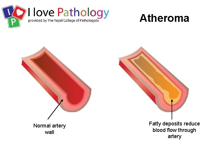 Atheroma Normal artery wall Fatty deposits reduce blood flow through artery 