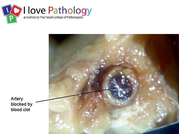 Artery blocked by blood clot 