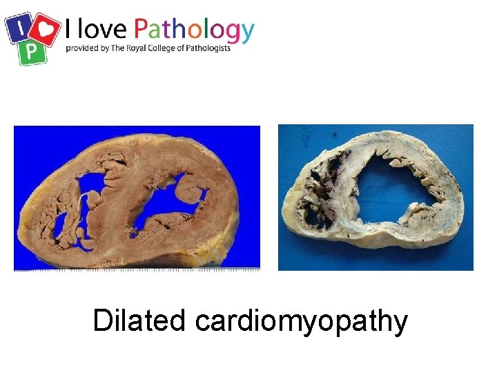 Dilated cardiomyopathy 