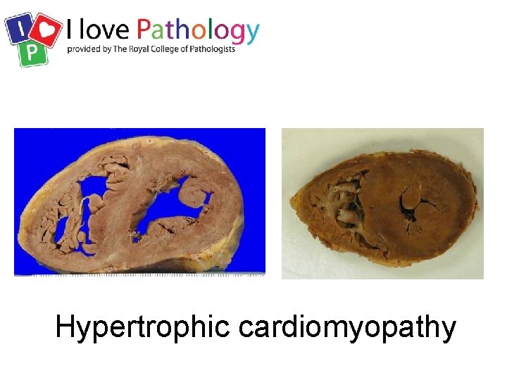 Hypertrophic cardiomyopathy 