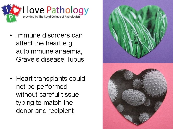  • Immune disorders can affect the heart e. g. autoimmune anaemia, Grave’s disease,