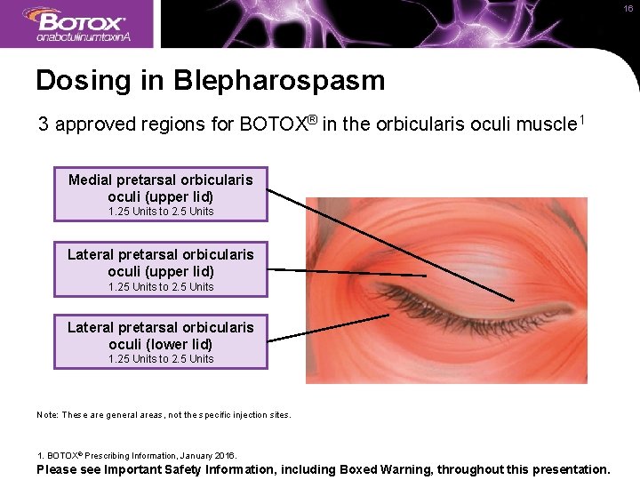 16 Dosing in Blepharospasm 3 approved regions for BOTOX® in the orbicularis oculi muscle