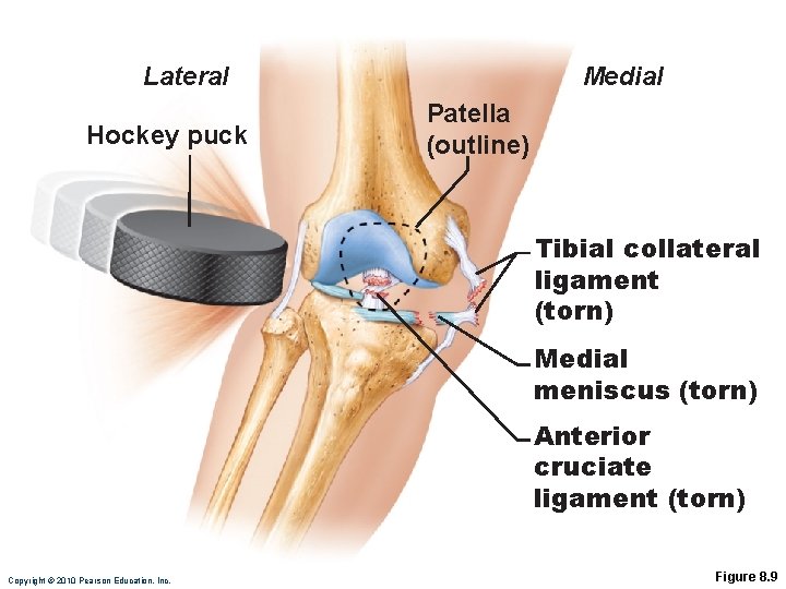 Lateral Hockey puck Medial Patella (outline) Tibial collateral ligament (torn) Medial meniscus (torn) Anterior
