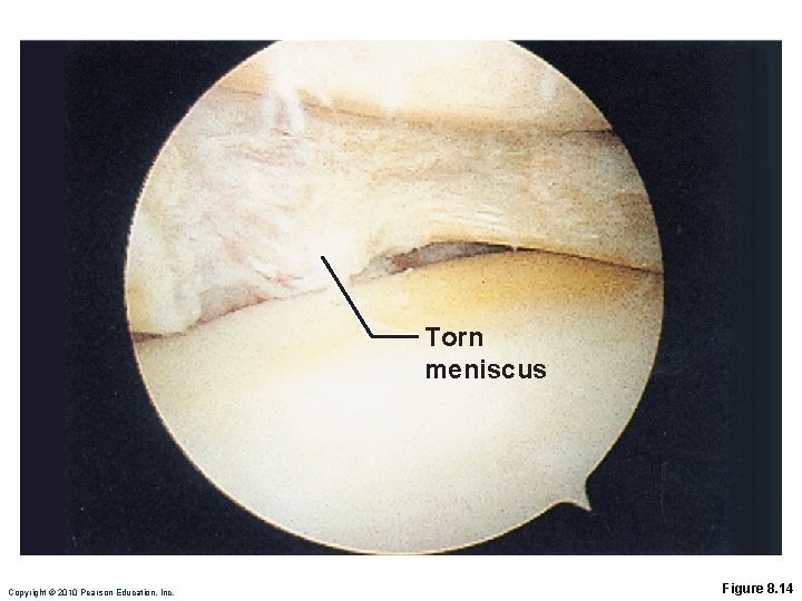 Torn meniscus Copyright © 2010 Pearson Education, Inc. Figure 8. 14 