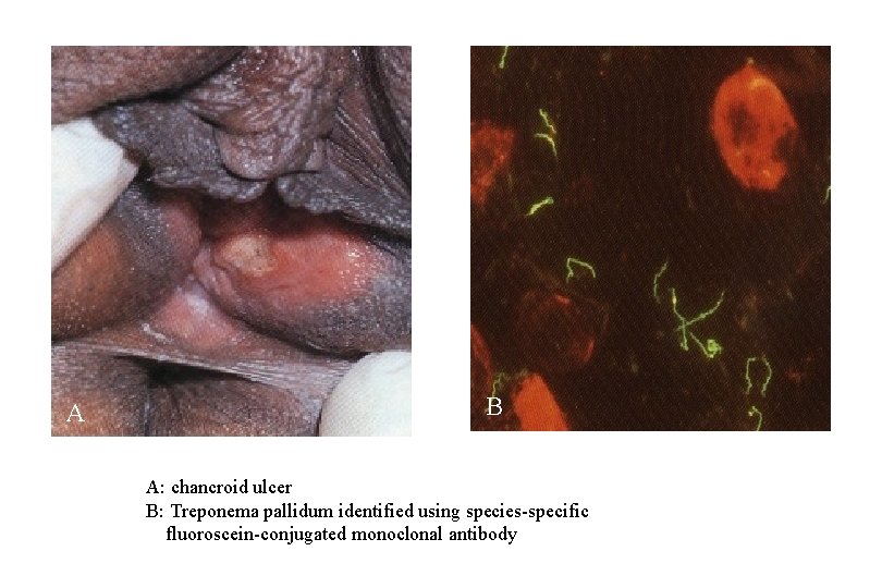 A B A: chancroid ulcer B: Treponema pallidum identified using species-specific fluoroscein-conjugated monoclonal antibody