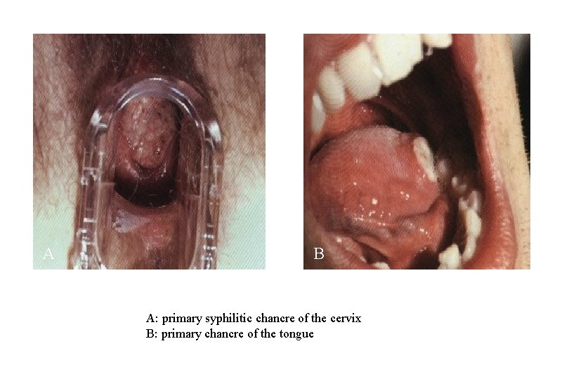A B A: primary syphilitic chancre of the cervix B: primary chancre of the