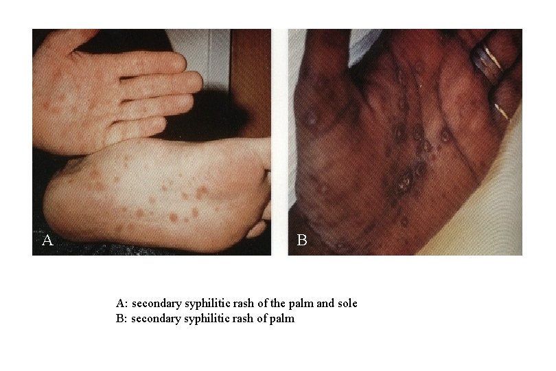 A B A: secondary syphilitic rash of the palm and sole B: secondary syphilitic