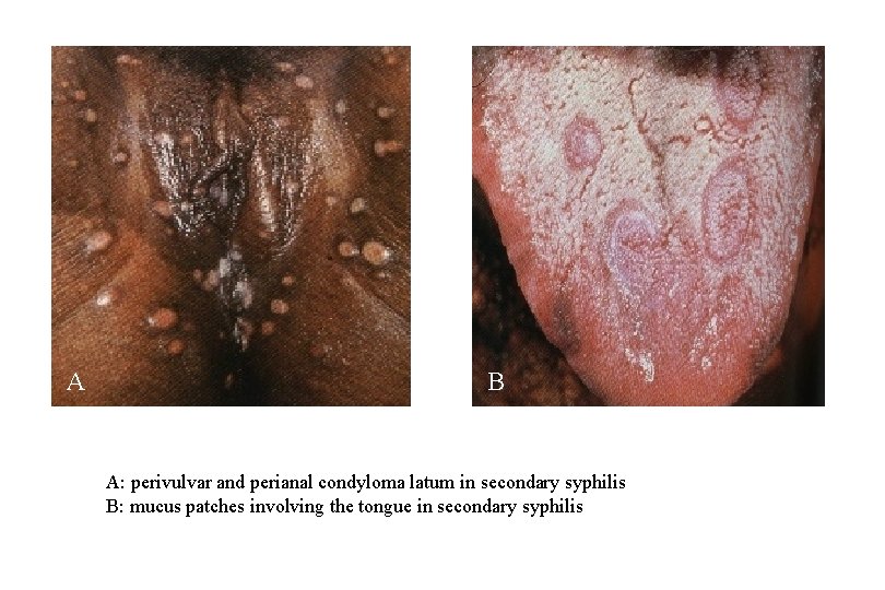 A B A: perivulvar and perianal condyloma latum in secondary syphilis B: mucus patches