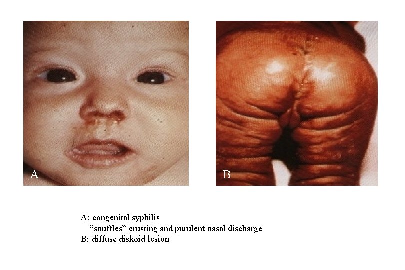 A B A: congenital syphilis “snuffles” crusting and purulent nasal discharge B: diffuse diskoid