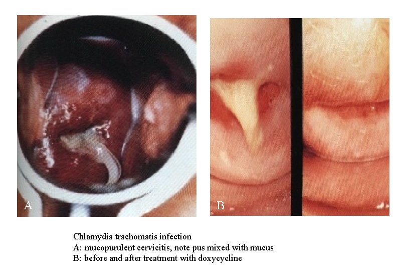 A B Chlamydia trachomatis infection A: mucopurulent cervicitis, note pus mixed with mucus B: