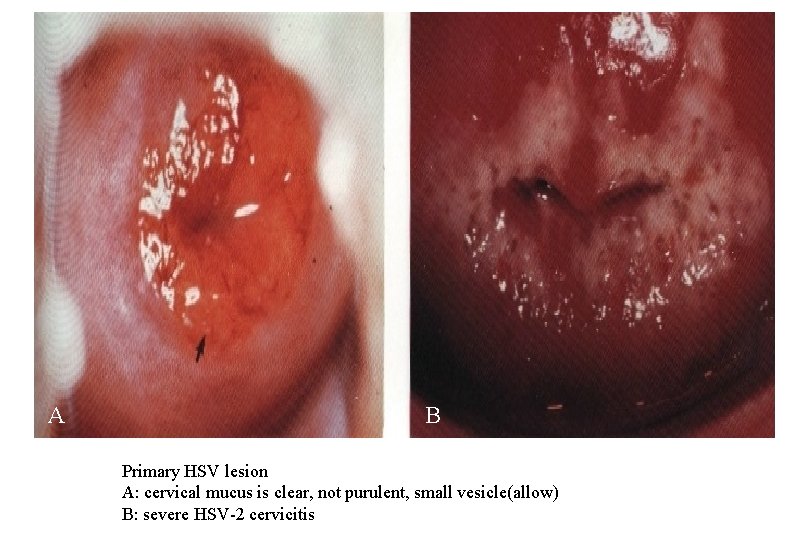 A B Primary HSV lesion A: cervical mucus is clear, not purulent, small vesicle(allow)