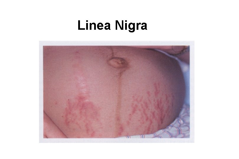 Linea Nigra 