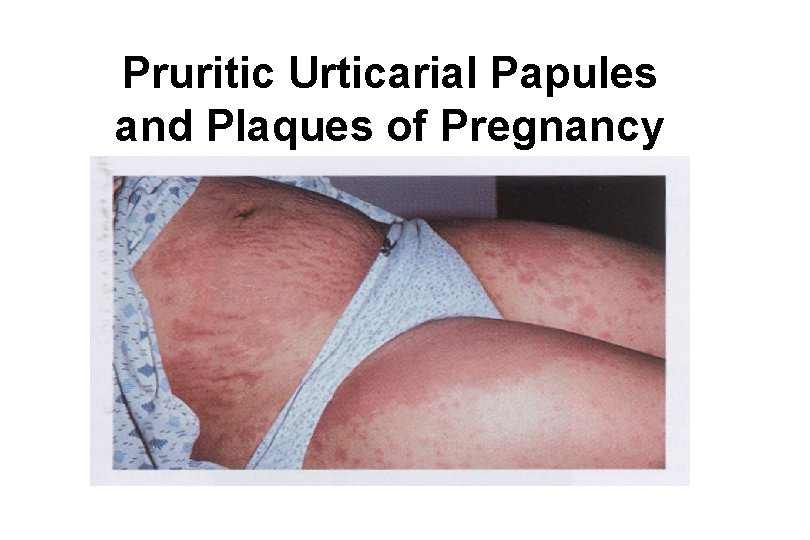 Pruritic Urticarial Papules and Plaques of Pregnancy 