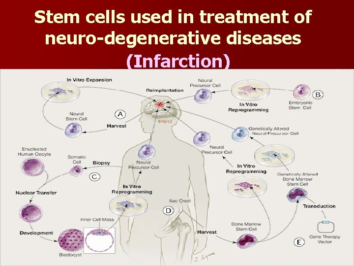 Stem cells used in treatment of neuro-degenerative diseases (Infarction) 