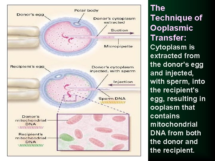 The Technique of Ooplasmic Transfer: Cytoplasm is extracted from the donor's egg and injected,