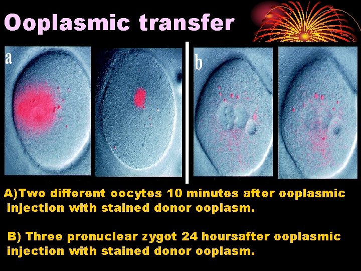 Ooplasmic transfer A)Two different oocytes 10 minutes after ooplasmic injection with stained donor ooplasm.