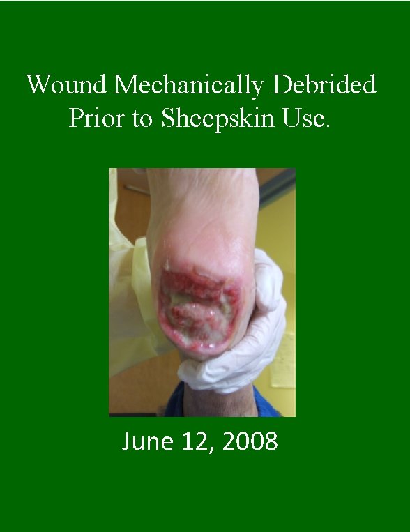 Wound Mechanically Debrided Prior to Sheepskin Use. June 12, 2008 