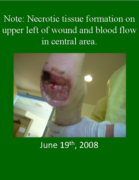 Note: Necrotic tissue formation on upper left of wound and blood flow in central