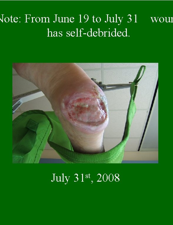 Note: From June 19 to July 31 has self-debrided. July 31 st, 2008 woun