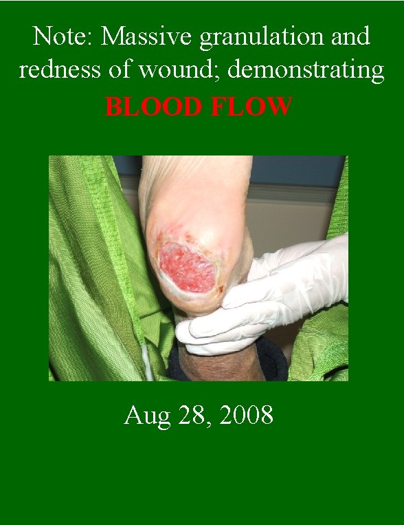 Note: Massive granulation and redness of wound; demonstrating BLOOD FLOW Aug 28, 2008 