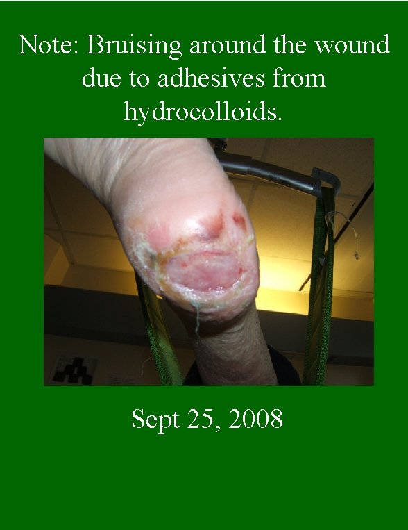 Note: Bruising around the wound due to adhesives from hydrocolloids. Sept 25, 2008 