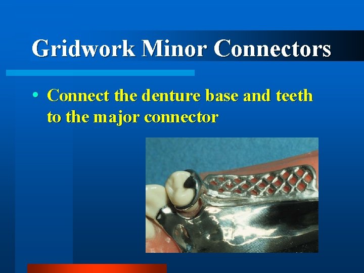 Gridwork Minor Connectors Connect the denture base and teeth to the major connector 