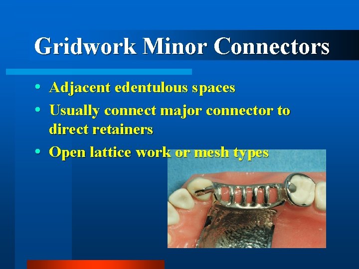 Gridwork Minor Connectors Adjacent edentulous spaces Usually connect major connector to direct retainers Open
