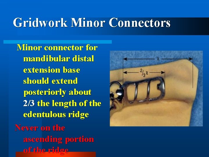 Gridwork Minor Connectors Minor connector for mandibular distal extension base should extend posteriorly about