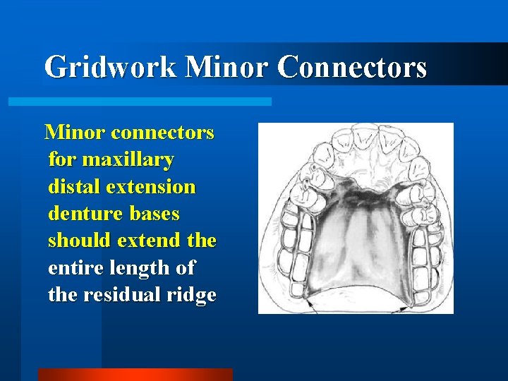Gridwork Minor Connectors Minor connectors for maxillary distal extension denture bases should extend the