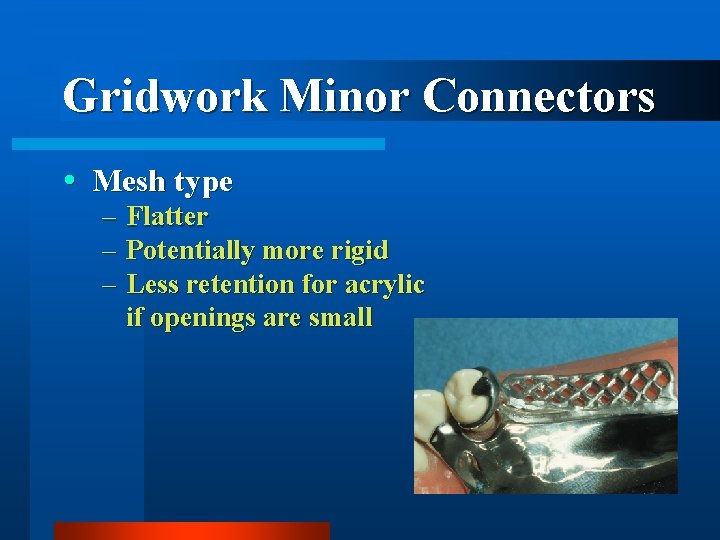 Gridwork Minor Connectors Mesh type – – – Flatter Potentially more rigid Less retention