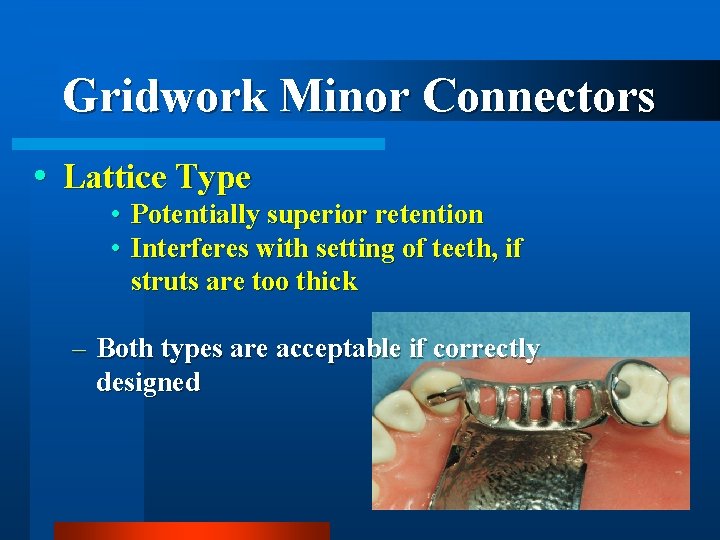 Gridwork Minor Connectors Lattice Type • Potentially superior retention • Interferes with setting of