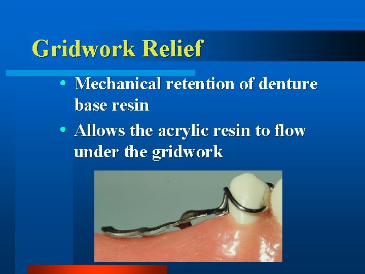 Gridwork Relief Mechanical retention of denture base resin Allows the acrylic resin to flow