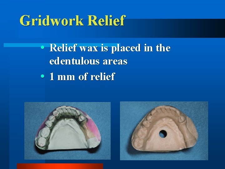 Gridwork Relief wax is placed in the edentulous areas 1 mm of relief 