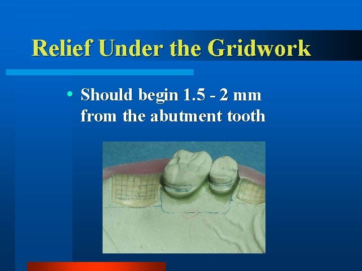 Relief Under the Gridwork Should begin 1. 5 - 2 mm from the abutment