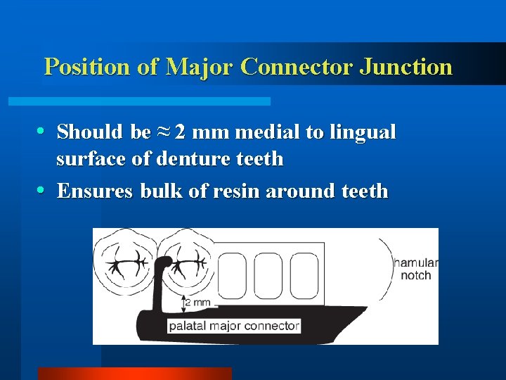 Position of Major Connector Junction Should be ≈ 2 mm medial to lingual surface