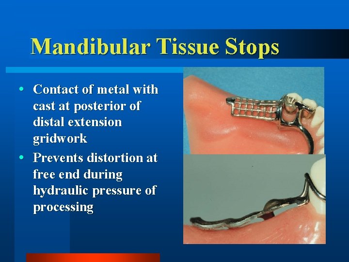 Mandibular Tissue Stops Contact of metal with cast at posterior of distal extension gridwork