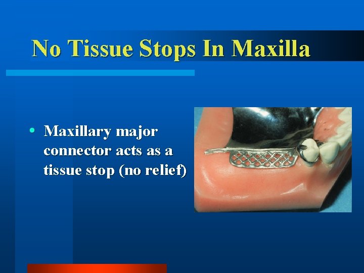 No Tissue Stops In Maxillary major connector acts as a tissue stop (no relief)