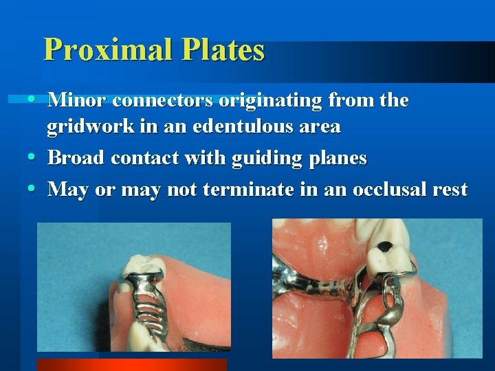Proximal Plates Minor connectors originating from the gridwork in an edentulous area Broad contact