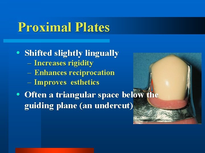 Proximal Plates Shifted slightly lingually – – – Increases rigidity Enhances reciprocation Improves esthetics