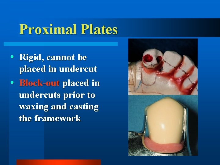 Proximal Plates Rigid, cannot be placed in undercut Block-out placed in undercuts prior to