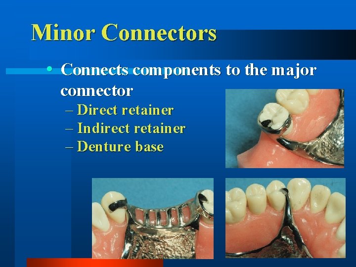 Minor Connectors Connects components to the major connector – Direct retainer – Indirect retainer