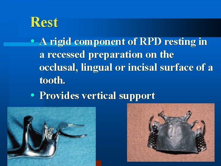 Rest A rigid component of RPD resting in a recessed preparation on the occlusal,