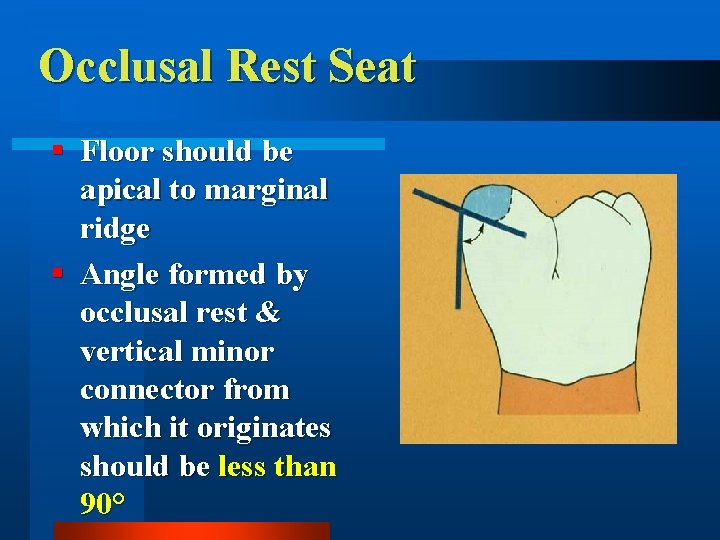 Occlusal Rest Seat § Floor should be apical to marginal ridge § Angle formed