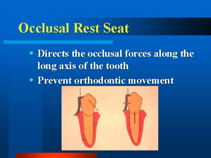 Occlusal Rest Seat Directs the occlusal forces along the long axis of the tooth