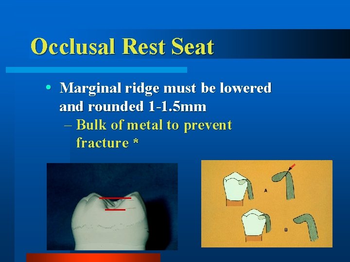 Occlusal Rest Seat Marginal ridge must be lowered and rounded 1 -1. 5 mm