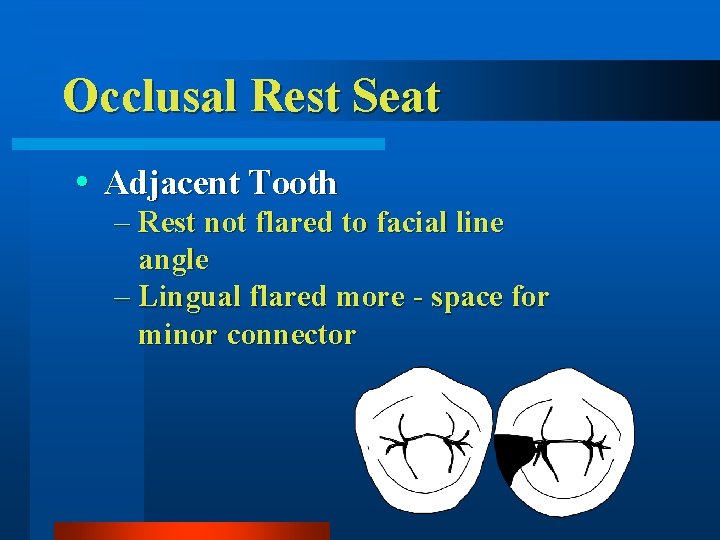 Occlusal Rest Seat Adjacent Tooth – Rest not flared to facial line angle –