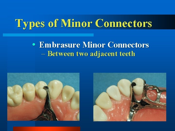 Types of Minor Connectors Embrasure Minor Connectors – Between two adjacent teeth 