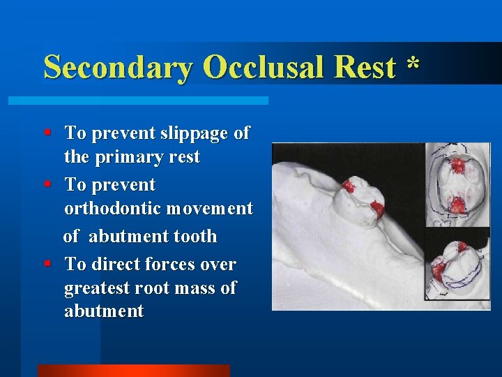 Secondary Occlusal Rest * § To prevent slippage of the primary rest § To