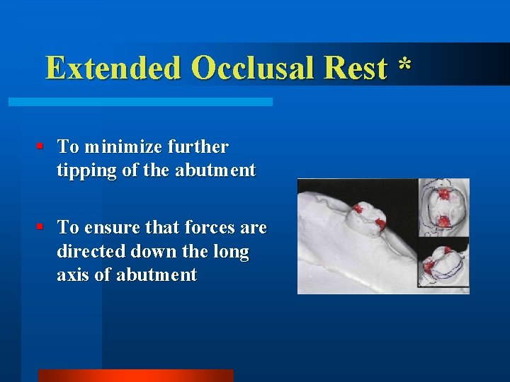 Extended Occlusal Rest * § To minimize further tipping of the abutment § To