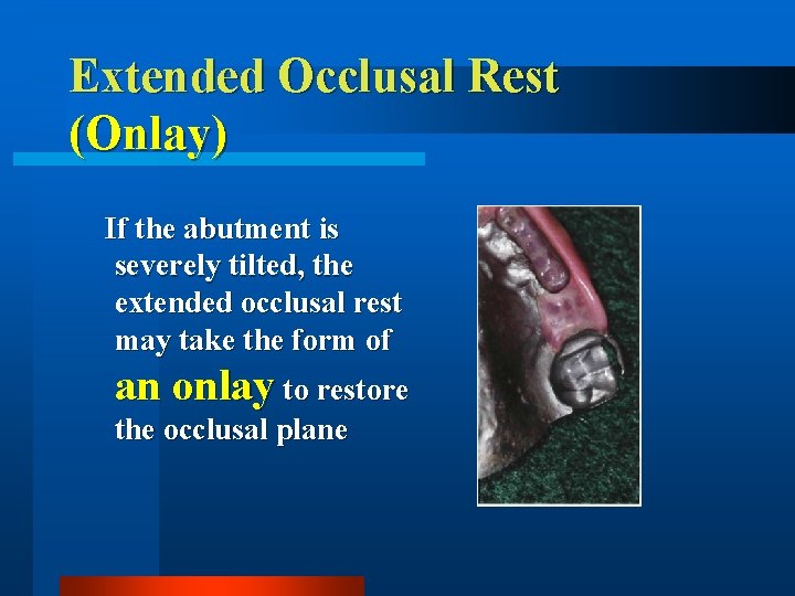 Extended Occlusal Rest (Onlay) If the abutment is severely tilted, the extended occlusal rest
